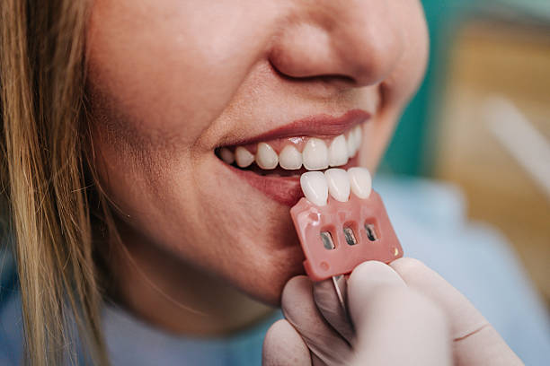 Teeth Whitening in Riyadh