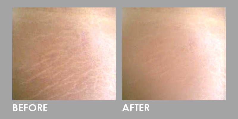 Expert dermatologist performing advanced laser treatment for birthmark and stretch mark removal to achieve smoother, healthier, and even-toned skin at Essence Skin Care.